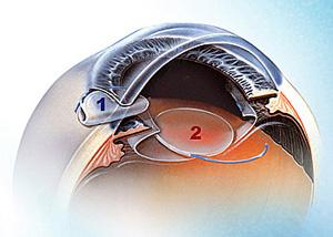 低温日皮视频APP下载安装人工晶体状