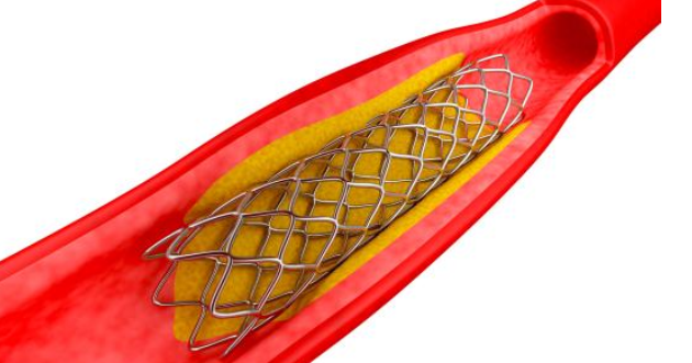 低温日皮视频APP下载安装技术对心血管支架药物涂层均匀性和牢固度提升-日皮视频免费看软件日皮视频APP在线看黄机